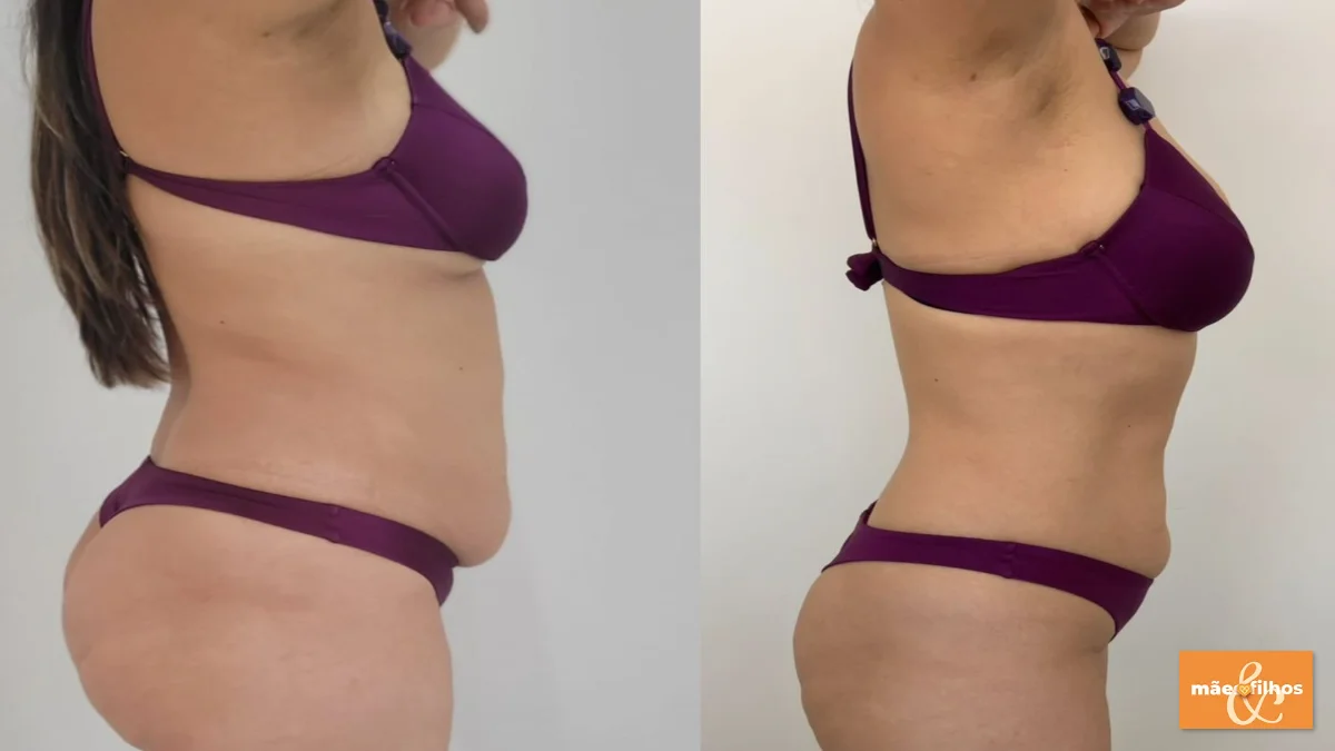Prime Shape: Protocolo Clínico da High Concept para Tratamento Integrado da Gordura Abdominal
